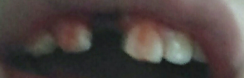 这是我的牙……
